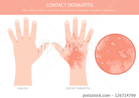 Contact dermatitis. Skin diseases. Medical infographic design Contact dermatitis. Skin diseases. Medical infographic design 126724799