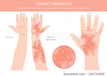 Contact dermatitis. Skin diseases. Medical infographic design Contact dermatitis. Skin diseases. Medical infographic design 126724800