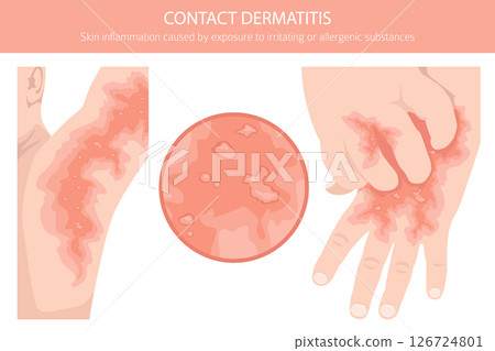 Contact dermatitis. Skin diseases. Medical infographic design Contact dermatitis. Skin diseases. Medical infographic design 126724801