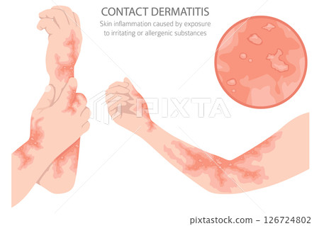 Contact dermatitis. Skin diseases. Medical infographic design Contact dermatitis. Skin diseases. Medical infographic design 126724802