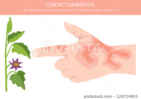 Contact dermatitis. Skin diseases. Medical infographic design 126724803