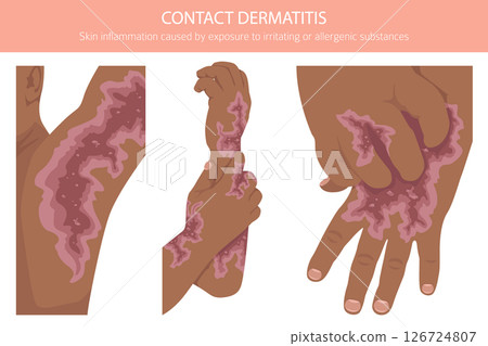 Contact dermatitis. Skin diseases. Medical infographic design Contact dermatitis. Skin diseases. Medical infographic design 126724807