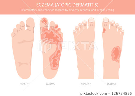 Eczema. Atopic dermatitis. Skin diseases. Medical infographic design 126724856