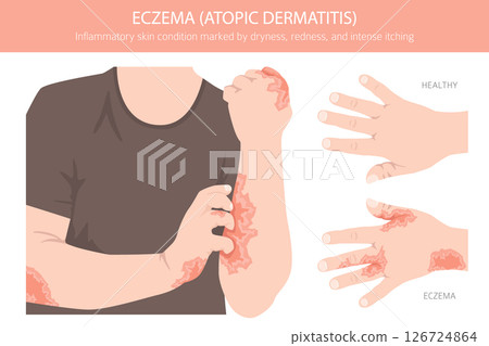 Eczema. Atopic dermatitis. Skin diseases. Medical infographic design Eczema. Atopic dermatitis. Skin diseases. Medical infographic design 126724864