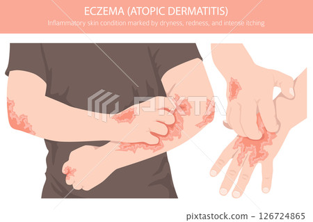 Eczema. Atopic dermatitis. Skin diseases. Medical infographic design 126724865