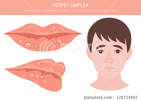 Herpes Simplex. Skin diseases. Medical infographic design 126724882