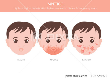 Impetigo. Skin diseases. Medical infographic design 126724922