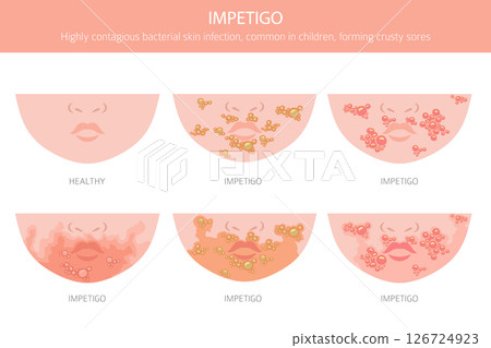Impetigo. Skin diseases. Medical infographic design 126724923