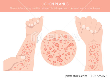 Lichen Planus. Skin diseases. Medical infographic design Lichen Planus. Skin diseases. Medical infographic design 126725078