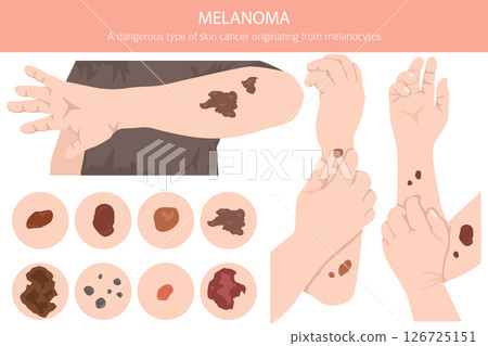 Melanoma. Skin diseases. Medical infographic design 126725151