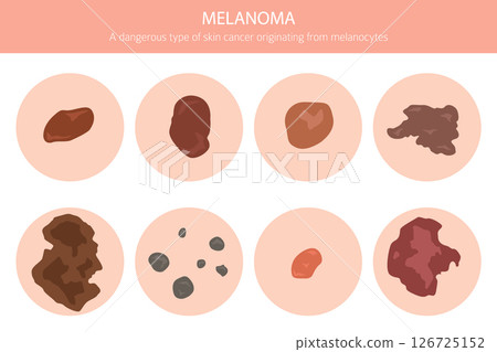 Melanoma. Skin diseases. Medical infographic design 126725152