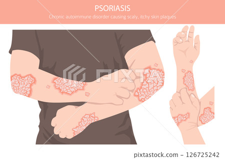 Psoriasis. Skin diseases. Medical infographic design 126725242