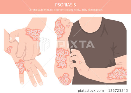 Psoriasis. Skin diseases. Medical infographic design Psoriasis. Skin diseases. Medical infographic design 126725243