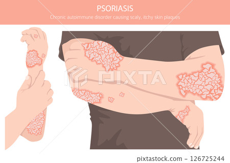Psoriasis. Skin diseases. Medical infographic design Psoriasis. Skin diseases. Medical infographic design 126725244