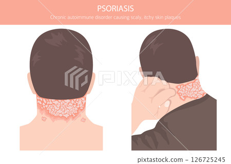 Psoriasis. Skin diseases. Medical infographic design Psoriasis. Skin diseases. Medical infographic design 126725245