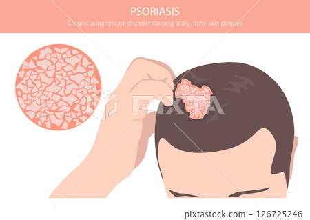 Psoriasis. Skin diseases. Medical infographic design Psoriasis. Skin diseases. Medical infographic design 126725246
