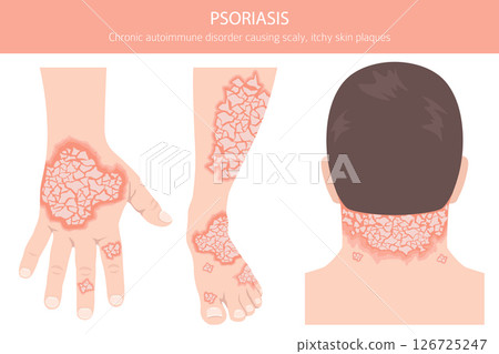Psoriasis. Skin diseases. Medical infographic design Psoriasis. Skin diseases. Medical infographic design 126725247