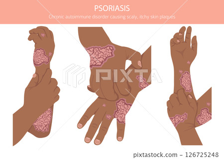 Psoriasis. Skin diseases. Medical infographic design Psoriasis. Skin diseases. Medical infographic design 126725248