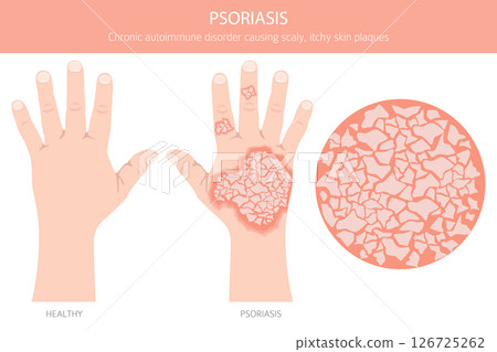 Psoriasis. Skin diseases. Medical infographic design 126725262