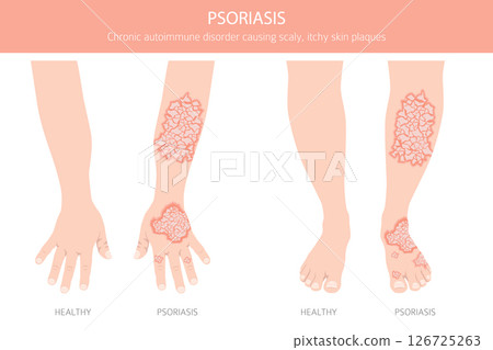 Psoriasis. Skin diseases. Medical infographic design Psoriasis. Skin diseases. Medical infographic design 126725263