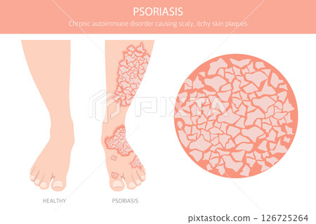 Psoriasis. Skin diseases. Medical infographic design 126725264