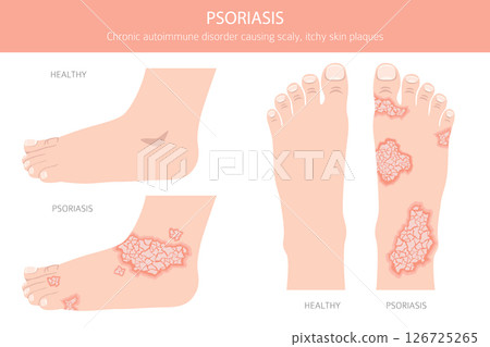 Psoriasis. Skin diseases. Medical infographic design 126725265