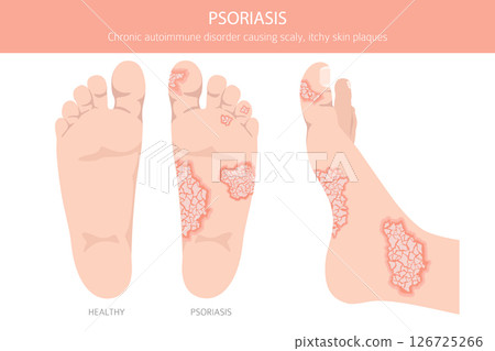 Psoriasis. Skin diseases. Medical infographic design 126725266