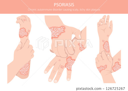 Psoriasis. Skin diseases. Medical infographic design 126725267