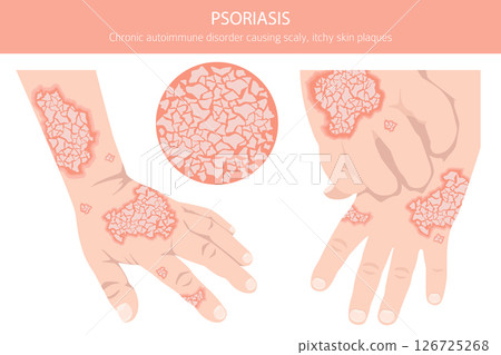 Psoriasis. Skin diseases. Medical infographic design Psoriasis. Skin diseases. Medical infographic design 126725268
