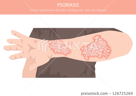 Psoriasis. Skin diseases. Medical infographic design 126725269