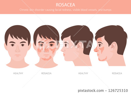 Rosacea. Skin diseases. Medical infographic design Rosacea. Skin diseases. Medical infographic design 126725310