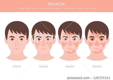 Rosacea. Skin diseases. Medical infographic design Rosacea. Skin diseases. Medical infographic design 126725311