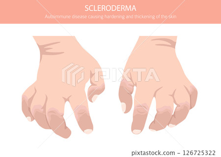 Scleroderma. Skin diseases. Medical infographic design Scleroderma. Skin diseases. Medical infographic design 126725322