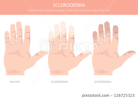 Scleroderma. Skin diseases. Medical infographic design Scleroderma. Skin diseases. Medical infographic design 126725323