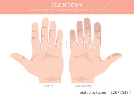 Scleroderma. Skin diseases. Medical infographic design 126725324