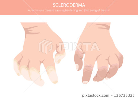 Scleroderma. Skin diseases. Medical infographic design 126725325
