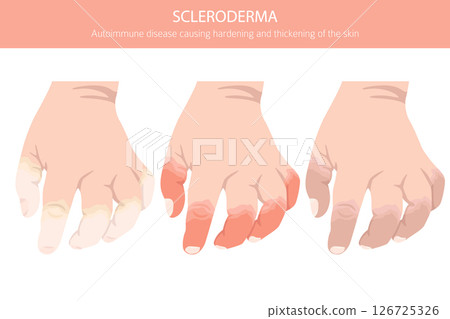 Scleroderma. Skin diseases. Medical infographic design 126725326