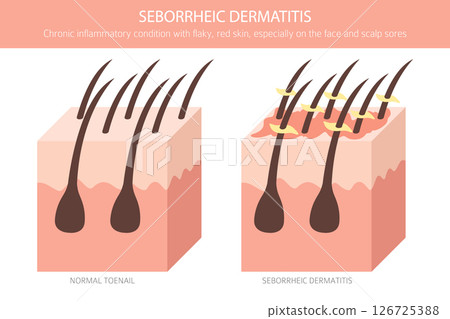 Seborrheic dermatitis. Skin diseases. Medical infographic design 126725388