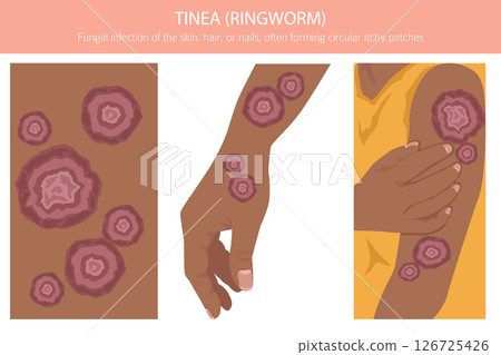 Tinea. Ringworm. Skin diseases. Medical infographic design 126725426