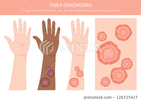 Tinea. Ringworm. Skin diseases. Medical infographic design 126725427