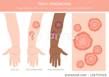 Tinea. Ringworm. Skin diseases. Medical infographic design Tinea. Ringworm. Skin diseases. Medical infographic design 126725428