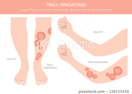 Tinea. Ringworm. Skin diseases. Medical infographic design Tinea. Ringworm. Skin diseases. Medical infographic design 126725430