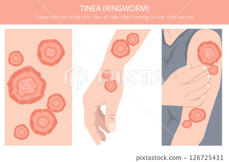 Tinea. Ringworm. Skin diseases. Medical infographic design Tinea. Ringworm. Skin diseases. Medical infographic design 126725431