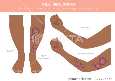 Tinea. Ringworm. Skin diseases. Medical infographic design 126725432