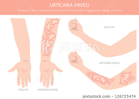 Urticaria. Hives. Skin diseases. Medical infographic design 126725474
