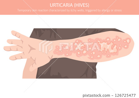 Urticaria. Hives. Skin diseases. Medical infographic design 126725477