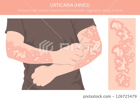 Urticaria. Hives. Skin diseases. Medical infographic design 126725479