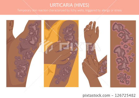 Urticaria. Hives. Skin diseases. Medical infographic design 126725482