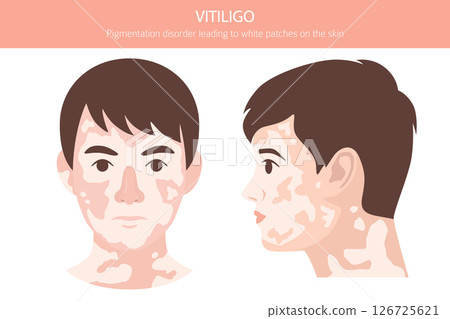 Vitiligo. Skin diseases. Medical infographic design Vitiligo. Skin diseases. Medical infographic design 126725621