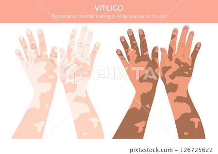 Vitiligo. Skin diseases. Medical infographic design 126725622